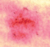 피부에 물리적 자극을 준 후의 상태