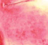 피부에 열 자극을 준 후 after care cream을 1회 도포 시 피부 진정 변화