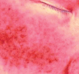 피부에 열 자극을 준 후 after care cream을 무도포 시 피부 진정 변화