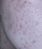 염증성 트러블 개선 후 피부