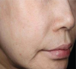 피부 윤광 개선 인체적용 시험 결과 전 이미지